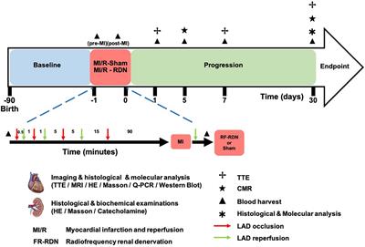 Renal Denervation Attenuates Adverse Remodeling and Intramyocardial Inflammation in Acute Myocardial Infarction With Ischemia–Reperfusion Injury